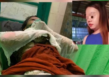 SJ, yang mengalami luka bakar dan inzet foto sebelum kejadian. (Ist)