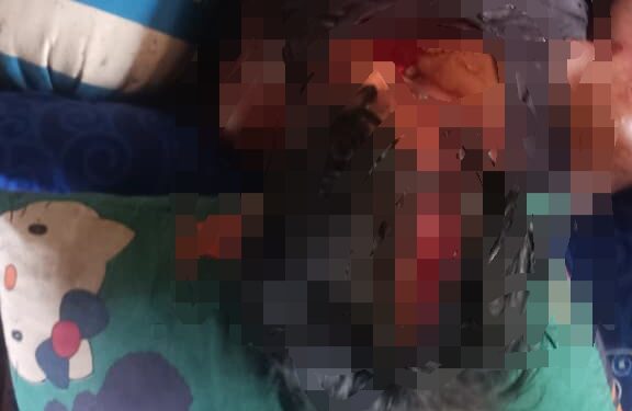Salah satu korban dugaan penganiaan di Kecamatan Sumber Barito, Rabu (30/9/2026). (ist)